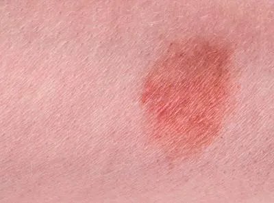 “鹤顶红”也能治疗白血病   介绍白血病的治疗方法