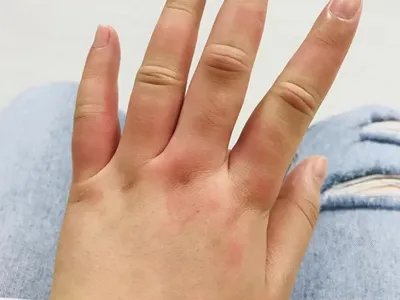 运动诱导性荨麻疹症状图片