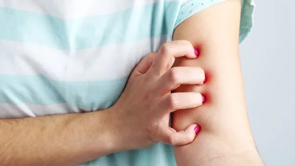 什么是人工性荨麻疹