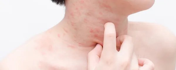 脚后跟脱皮怎么治