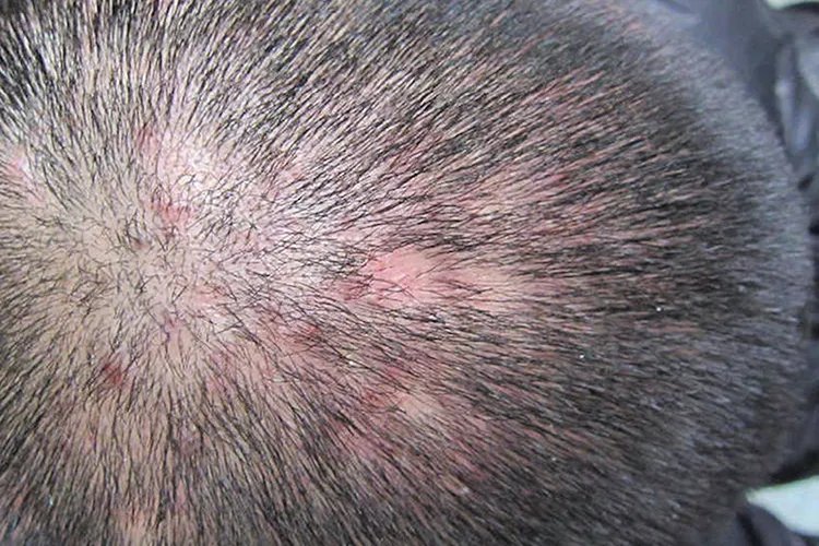 拔毛癖严重后果是什么样的