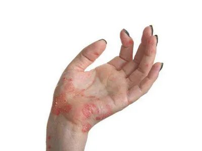 手部湿疹红斑图片