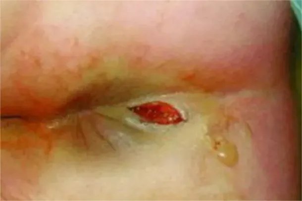 肛瘘的清晰图片