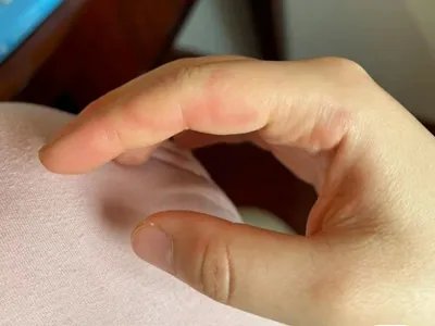 运动诱导性荨麻疹症状图片