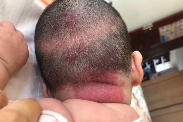 宝宝后脑勺鹤吻痕图片