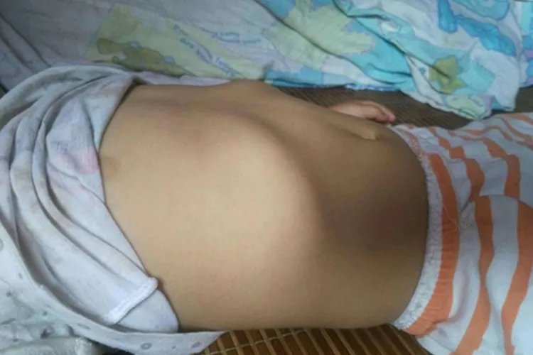 宝宝肋骨外翻图片