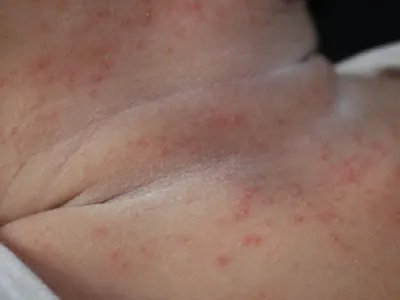 奶癣小红疙瘩图片
