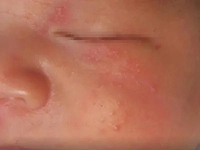 奶癣小红疙瘩图片