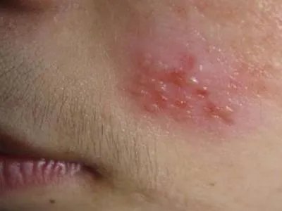 单纯疱疹水疱图片