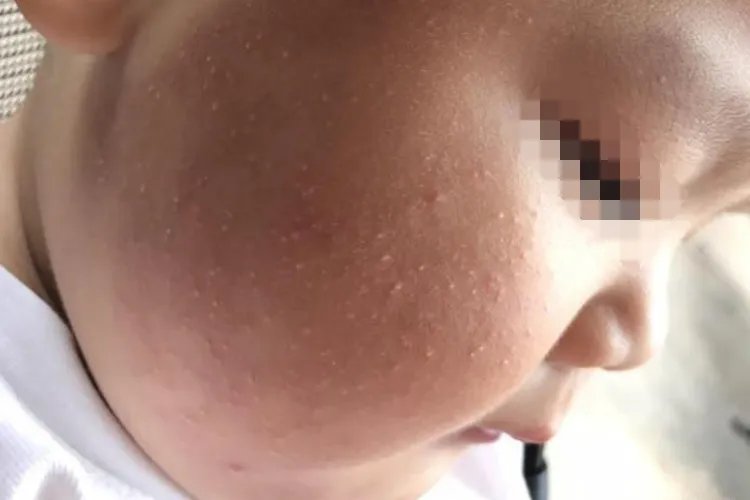 儿童毛周角化症图片