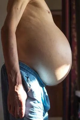 疝气的手术适应症有哪些