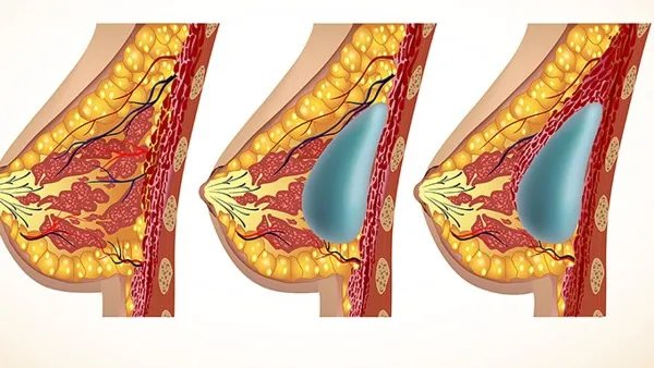 哺乳期乳腺炎症状有哪些，如何预防哺乳期乳腺炎？