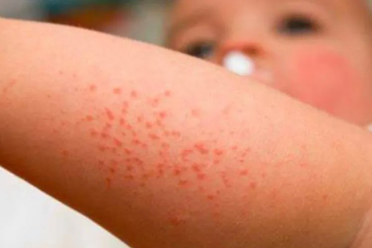 幼儿急疹小红点图片