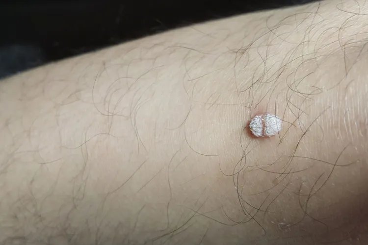 什么是刺瘊子图片大全