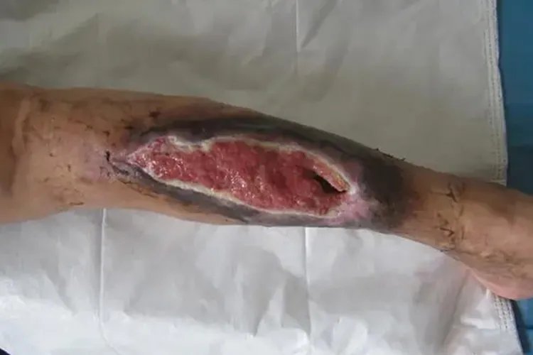 白血病人清创伤口图片