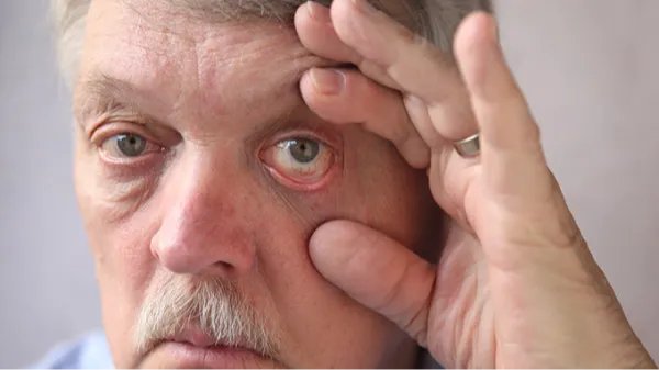 怎么去黑眼圈和眼袋