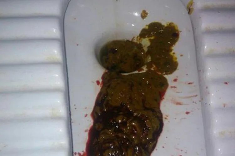 肠癌拉出来大便的图片