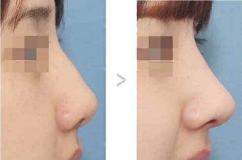 衢州整形膨体隆鼻失败的表现