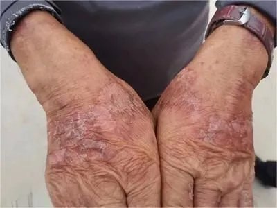 手部湿疹红斑图片
