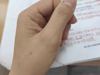 交界痣黑痣图片