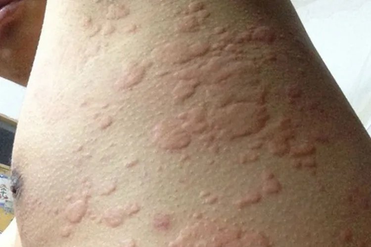 身上起了好多红疙瘩图片