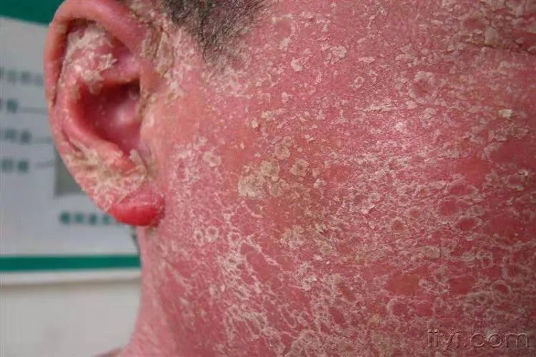 牛皮癣严重的图片