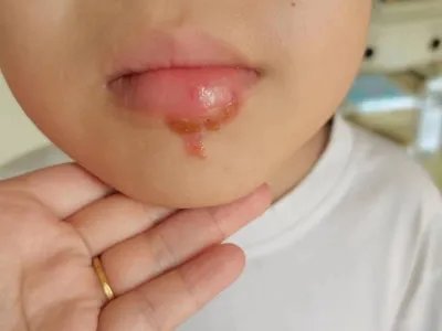 单纯疱疹水疱图片