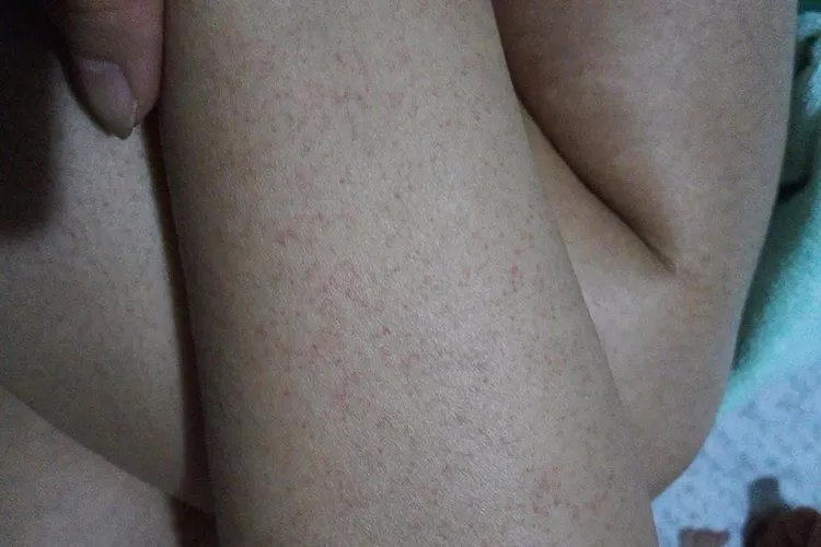 白血病红点图片