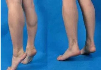 瘦腿针有效果吗