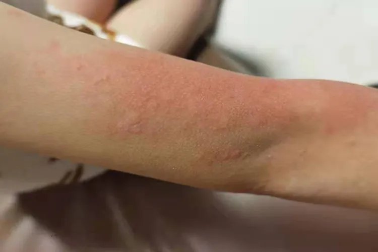 各种荨麻疹图片大全