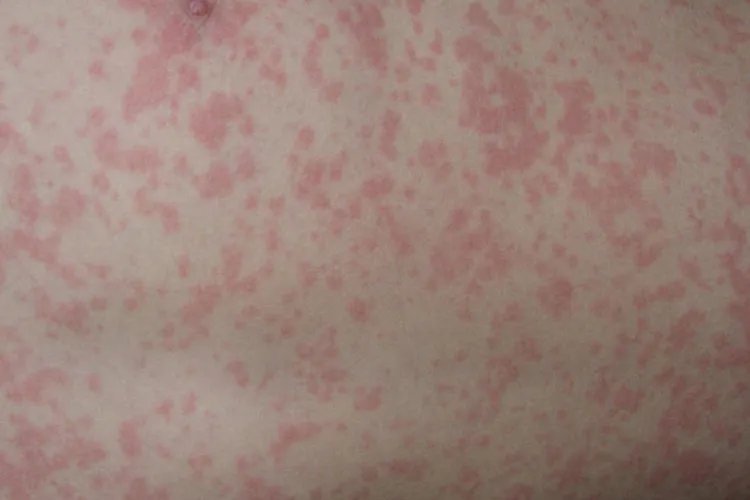小儿麻疹图片