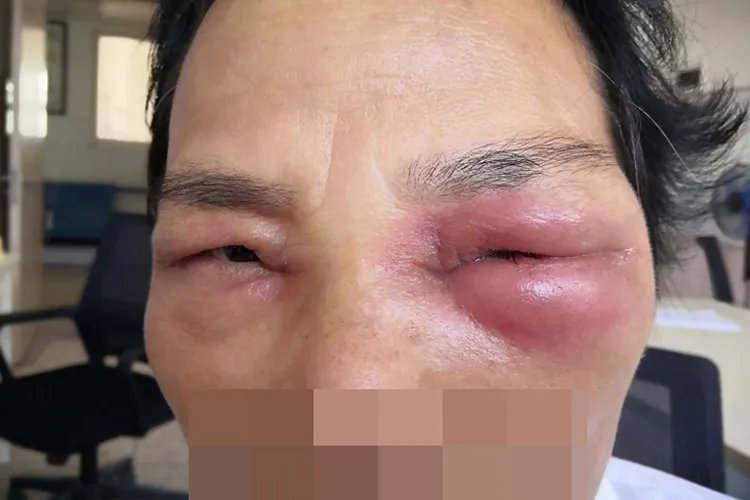 麦粒肿严重的图片