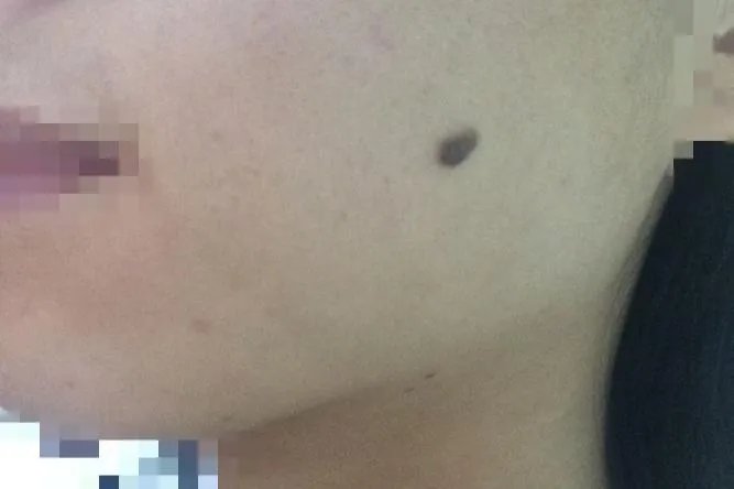 长痣的图片
