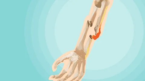 克雷斯骨折是什么