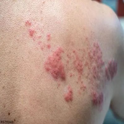 病毒性带状疱疹怎样算好了
