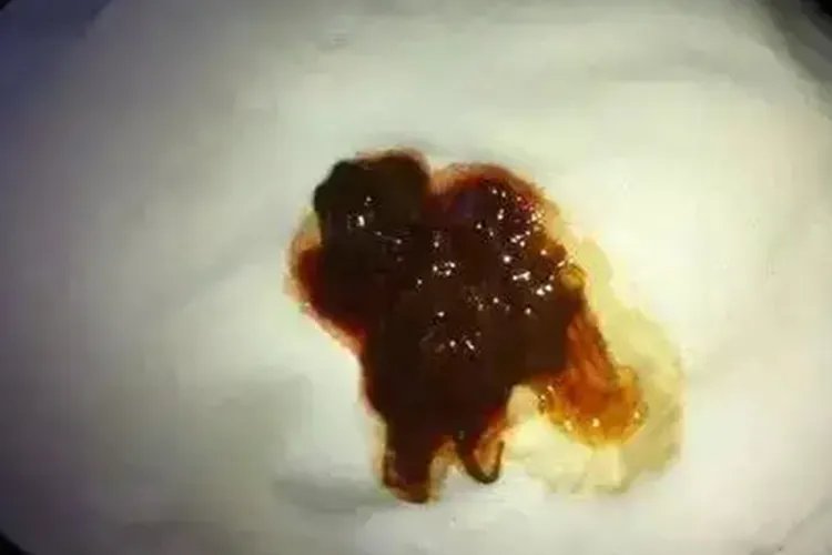 肠癌拉出来大便的图片