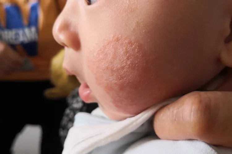 皮炎图片和症状用什么药