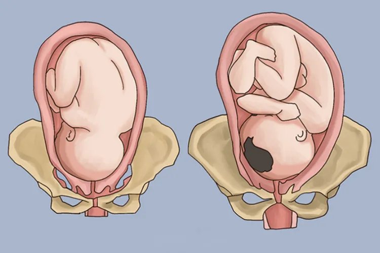 胎位LOA是什么位置
