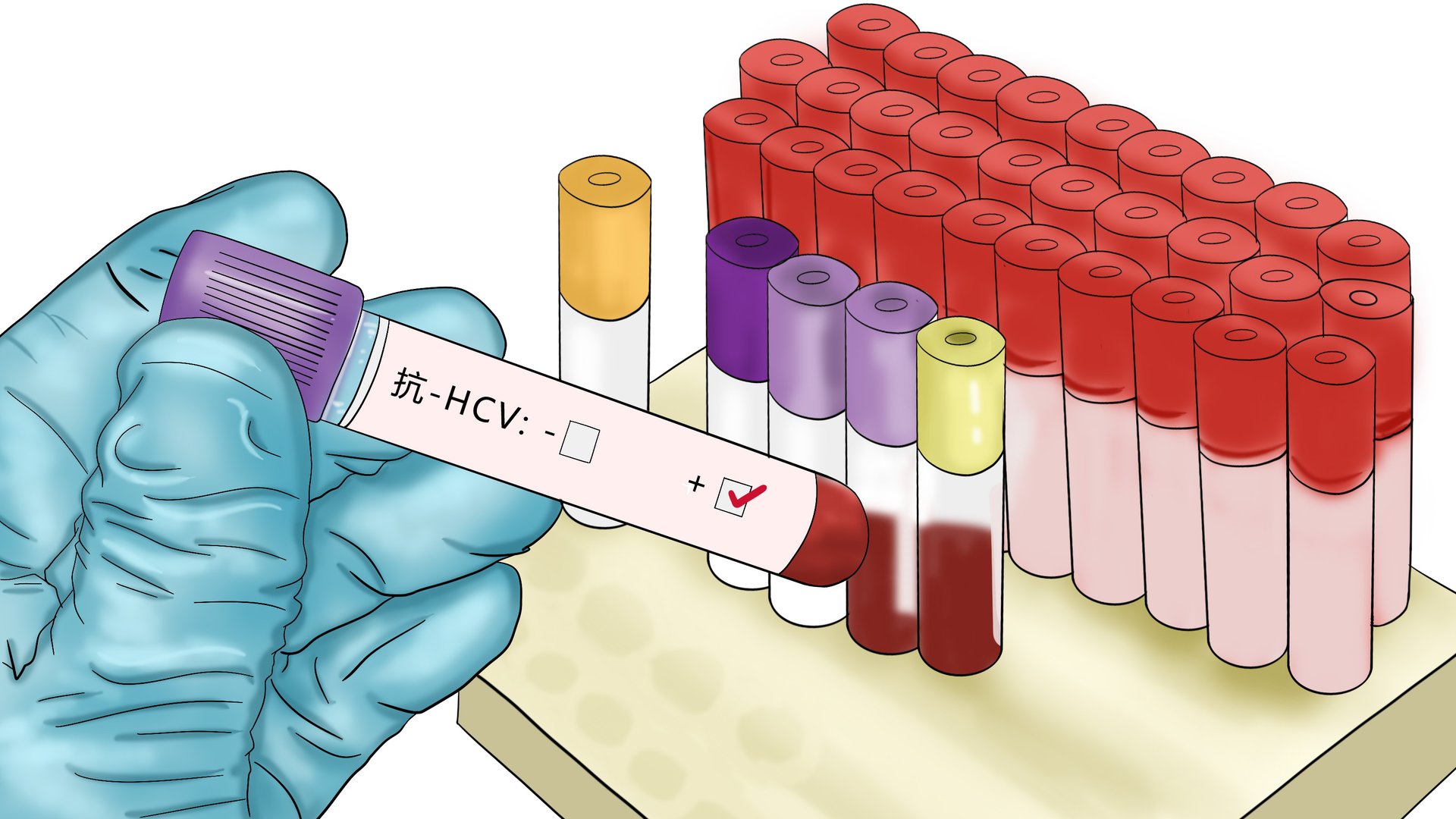 丙型肝炎病毒抗体
