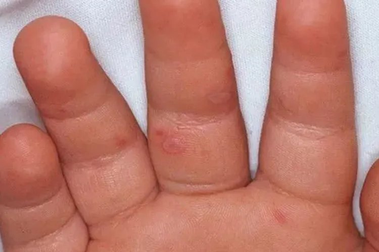 什么是手足口病图片