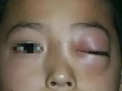 蜂窝织炎红肿图片