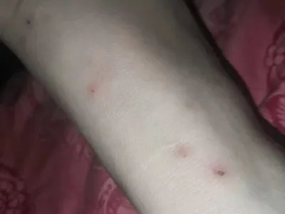 跳蚤叮咬小疙瘩图片