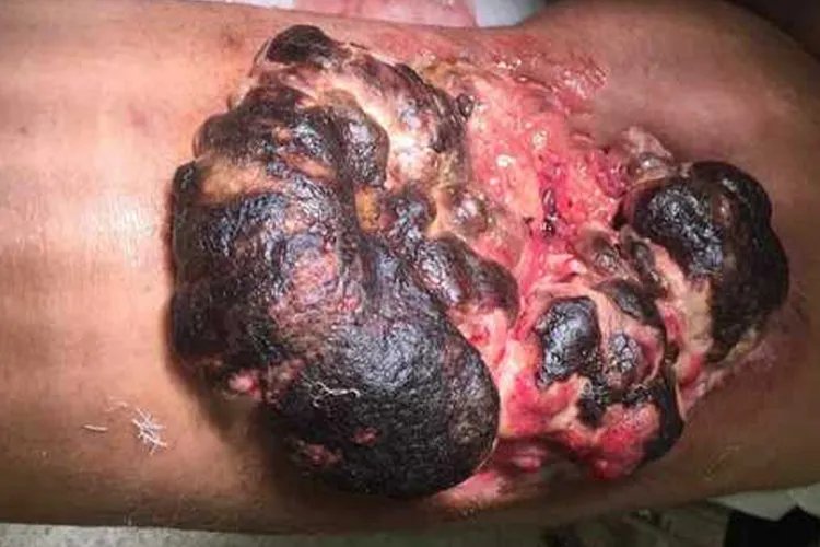 皮下脂肪瘤图片