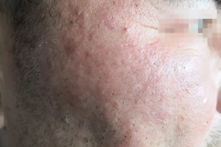 丹毒早期症状图片