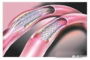 在未来，能做全身的血管支架手术吗？