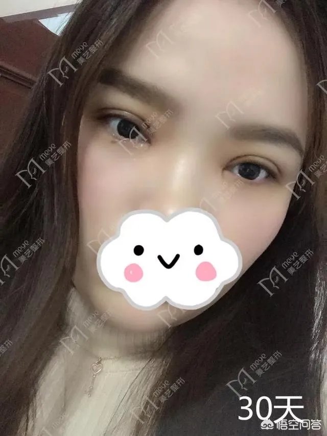 做双眼皮有几种方法?