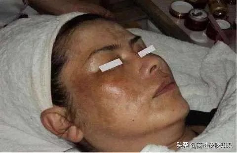 黄褐斑长什么样图片?