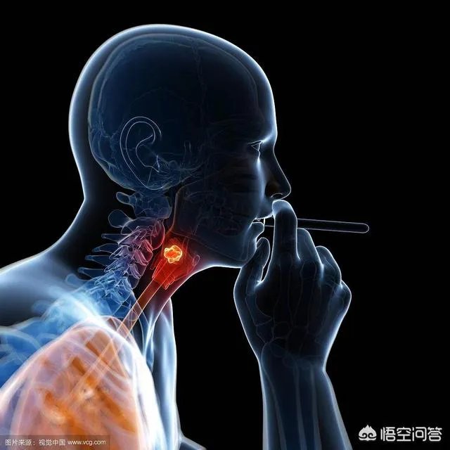 李咏到底是因为什么癌去世的？