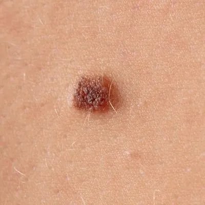 黑痣癌变的征兆有哪些