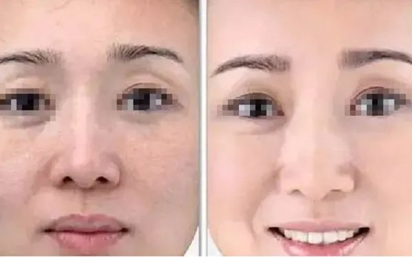 哪些人适合做小切口除皱术？